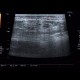 Angiolipoma, subcutaneous, selective embolisation: US - Ultrasound
